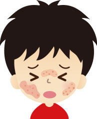 乳幼児・小児乾燥性湿疹とは