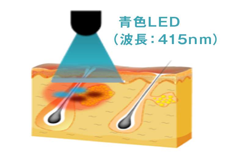 アクネ菌を光酸化作用によって破壊